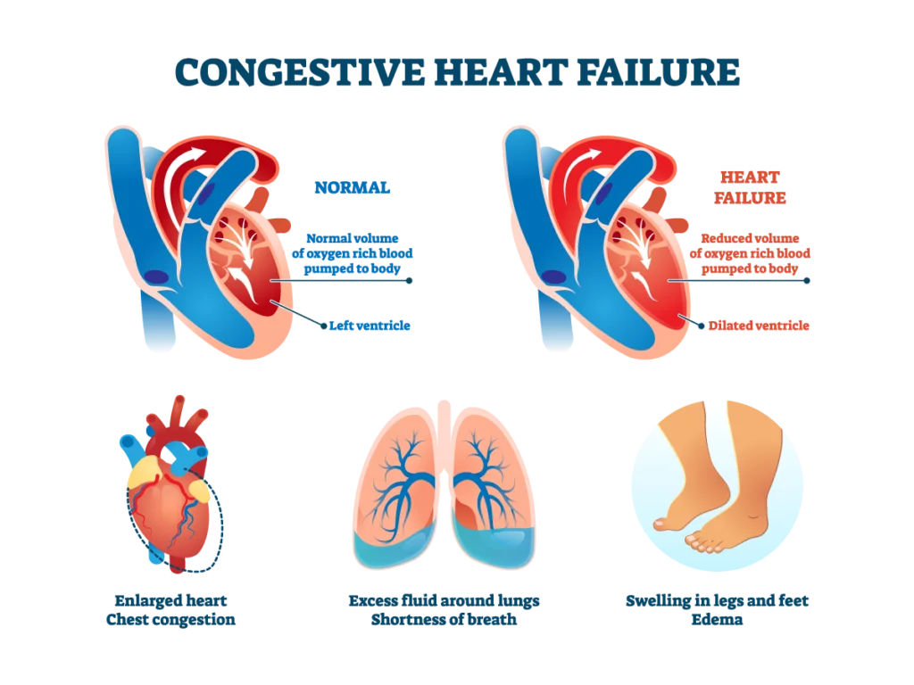 Illustrating Chronic Heart Failure: Dive into a visual representation of the condition, understanding its impact, symptoms, and management. Explore the complexities of heart health in this informative artwork.