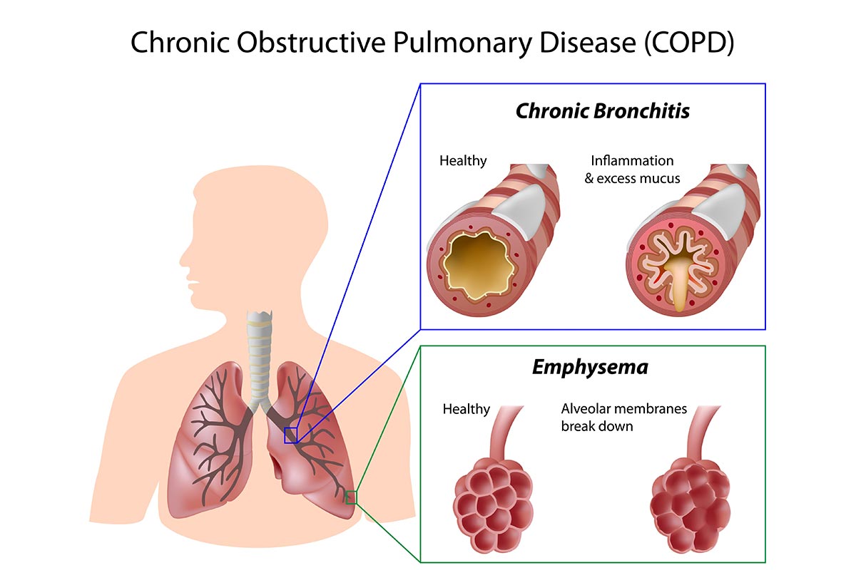 What Are the Four Stages of COPD? Sage Family of Companies