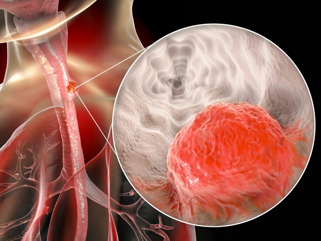 Visualizing Esophageal Cancer: A 3D illustration depicting a malignant tumor in the human esophagus, offering insights into this condition.