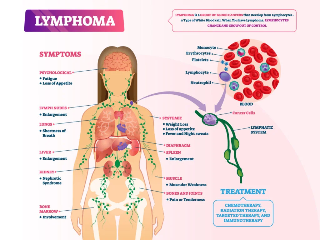 Understanding Lymphoma: An image revealing the intricate connection between lymphoma and the lymphatic system, shedding light on this condition.