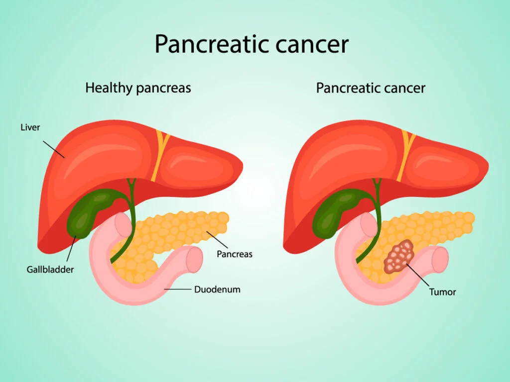 Discover the stark contrast between a healthy pancreas and one afflicted by cancer in this informative illustration. Explore the intricate details of these vital organs and gain valuable insights into the impact of cancer on the pancreas. Learn more about early detection and prevention strategies.
