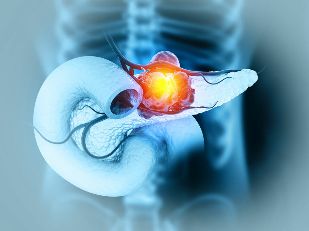 Explore a detailed medical illustration showcasing the complexities of pancreatic cancer. Gain a deeper understanding of this condition's impact on the pancreas and the human body. Get insights into its stages, symptoms, and treatment options.
