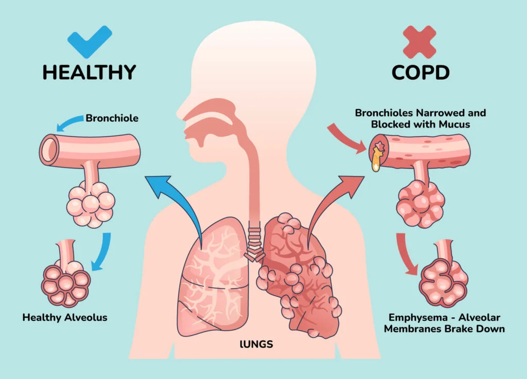 Illustration depicting healthy lungs and copd affects.