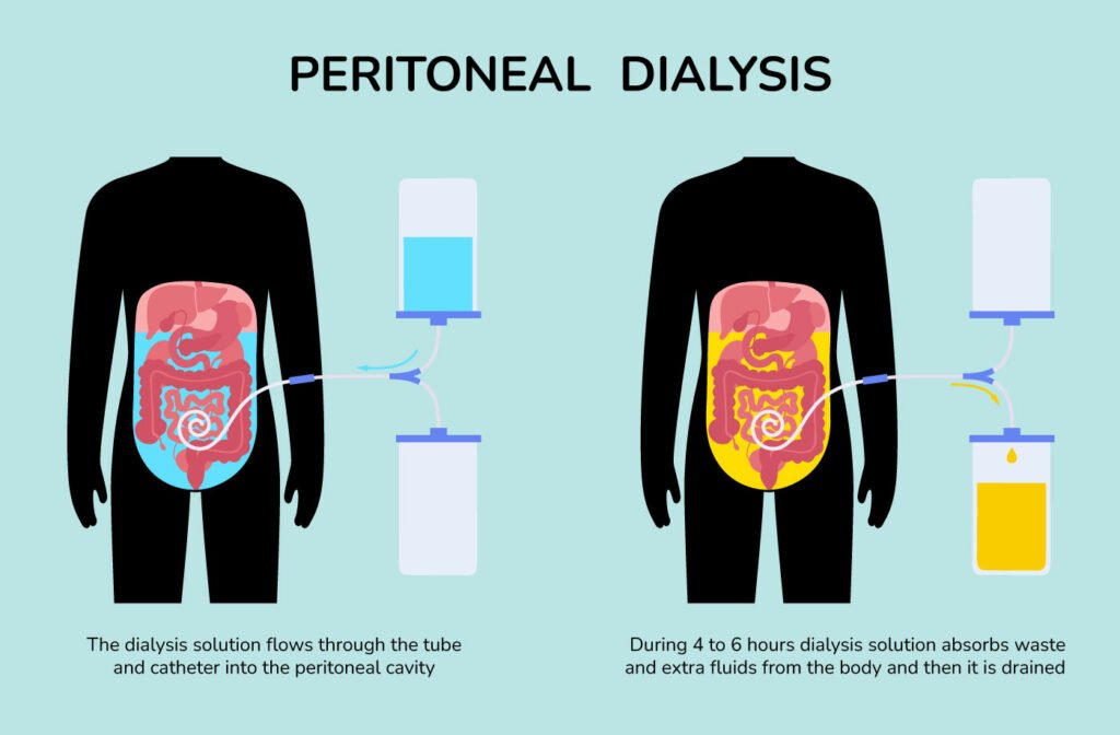 peritoneal dialysis infographic
